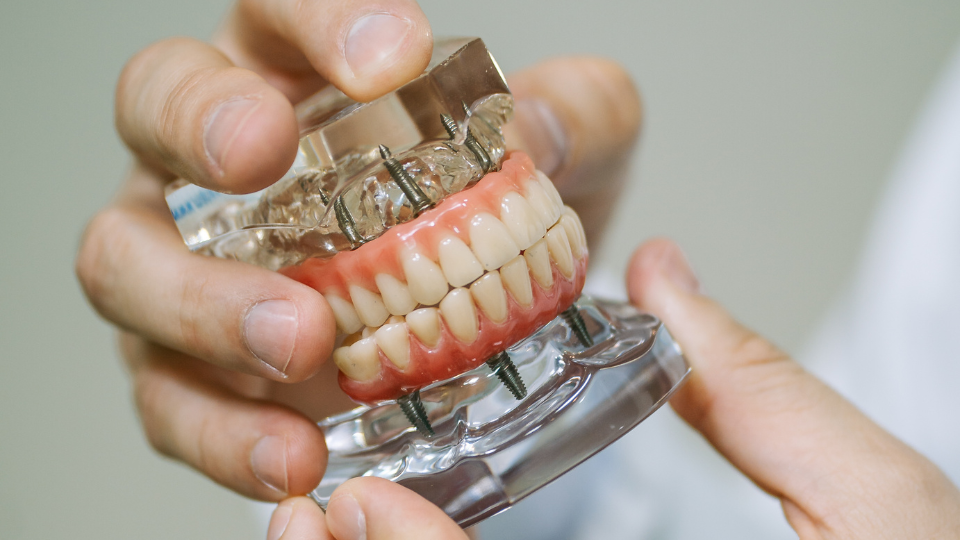 Implante Dentário: a solução moderna e duradoura para a perda de dentes